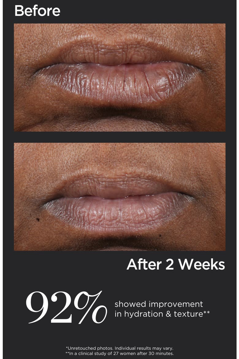 ColdPlasmaPlus+ Lip Therapy, Alternate, color, NO COLOR