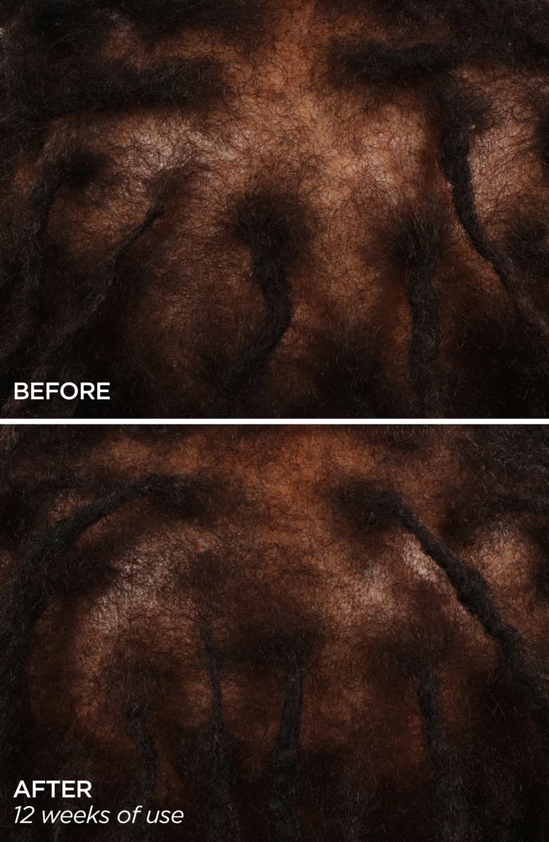 BeautyBio GloPRO<sup>®</sup> Rejuvenating Scalp + Fuller Hair Therapy Set, Alternate, color,