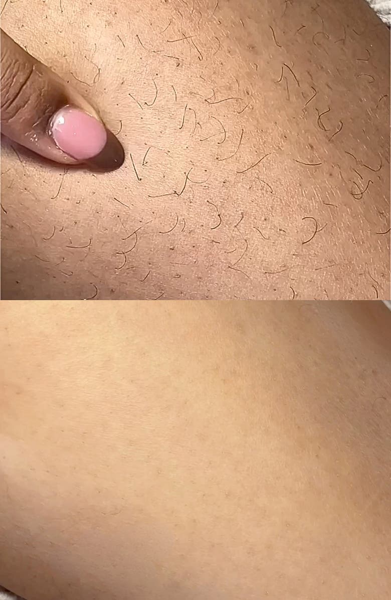 ANSWR Exfoliating Hair Removal Drop, Alternate, color, 