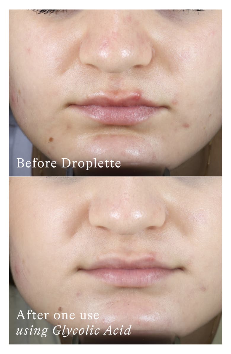 Droplette Microinfusion Device, Alternate, color, 