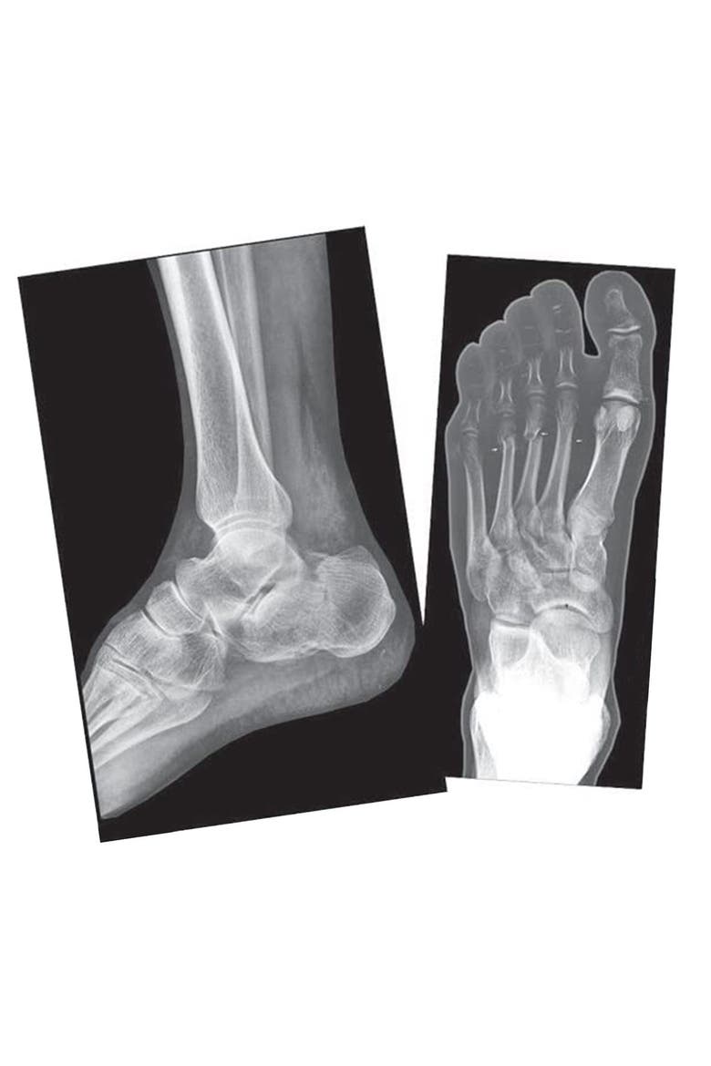 Broken Bones X-Rays, Alternate, color, Multicolor