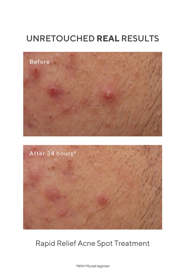 Rapid Relief Acne Spot Treatment, Alternate, color, NO COLOR