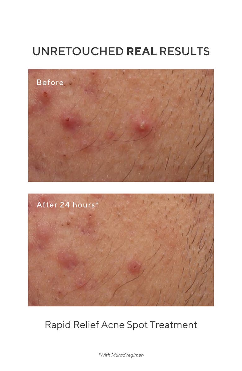 Murad<sup>®</sup> Rapid Relief Acne Spot Treatment, Alternate, color, 