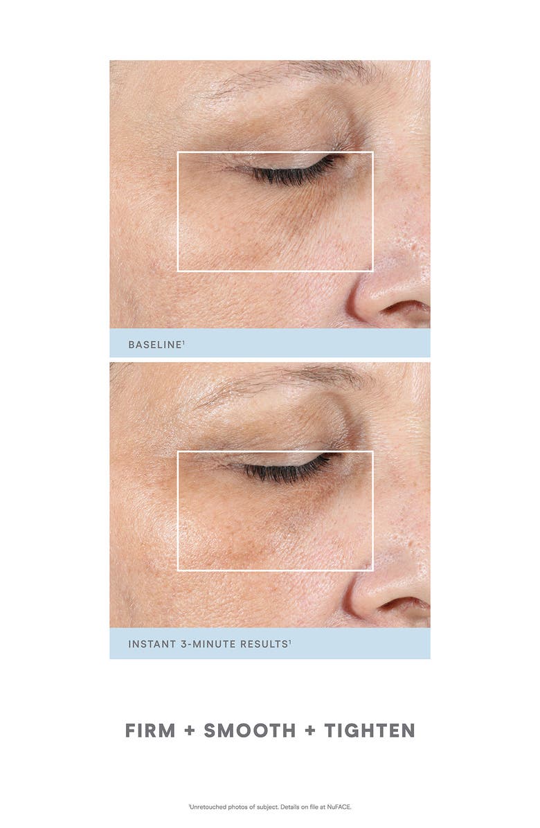 NuFACE<sup>®</sup> FIX<sup>®</sup> Starter Kit - Nude - Refurbished, Alternate, color,