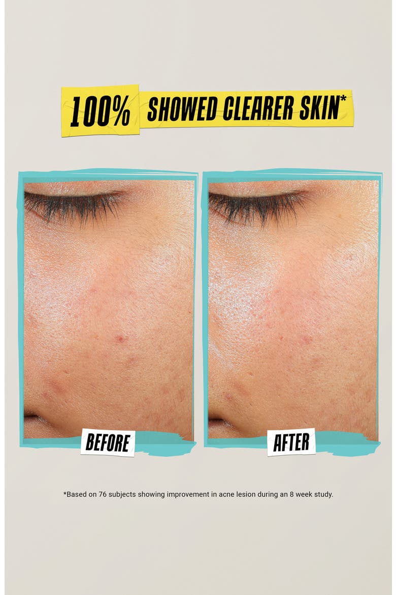 Expertly Clear Acne-Treating & Preventing Lotion, Alternate, color, NO COLOR
