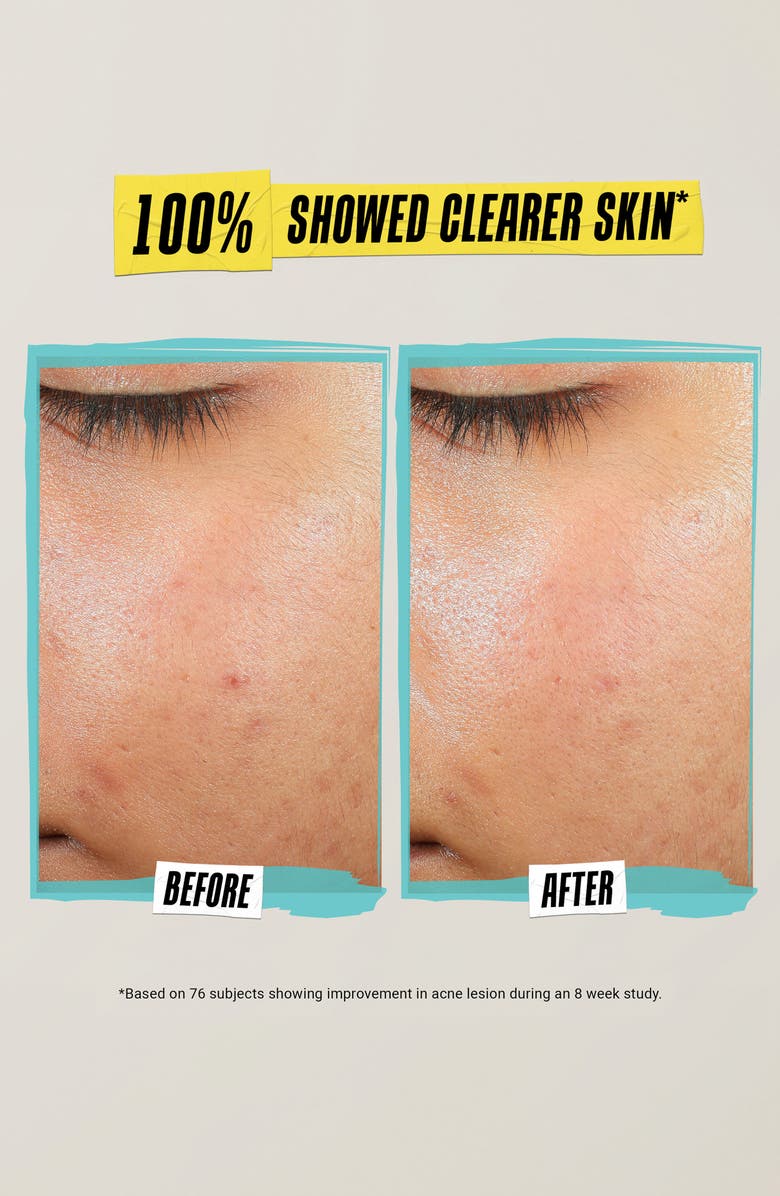 Kiehl's Since 1851 Expertly Clear Acne-Treating & Preventing Lotion, Alternate, color, 