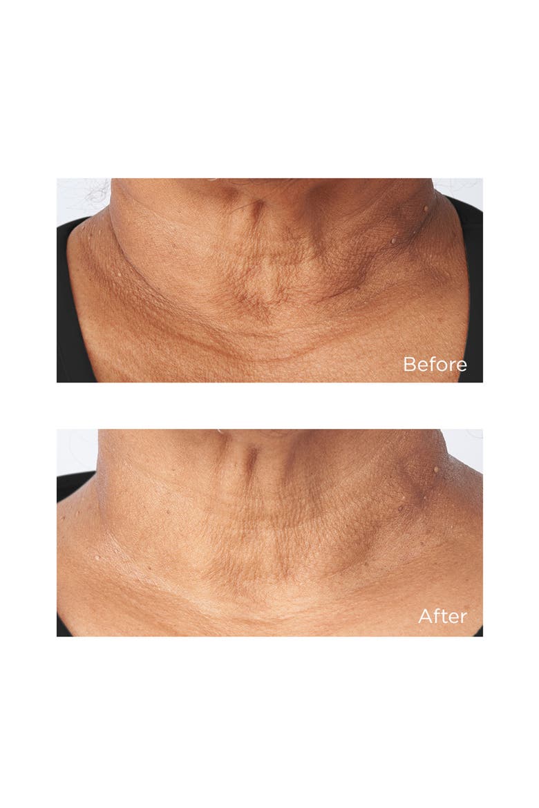 Cold Plasma+ Sub-D Neck Treatment, Alternate, color, NO COLOR