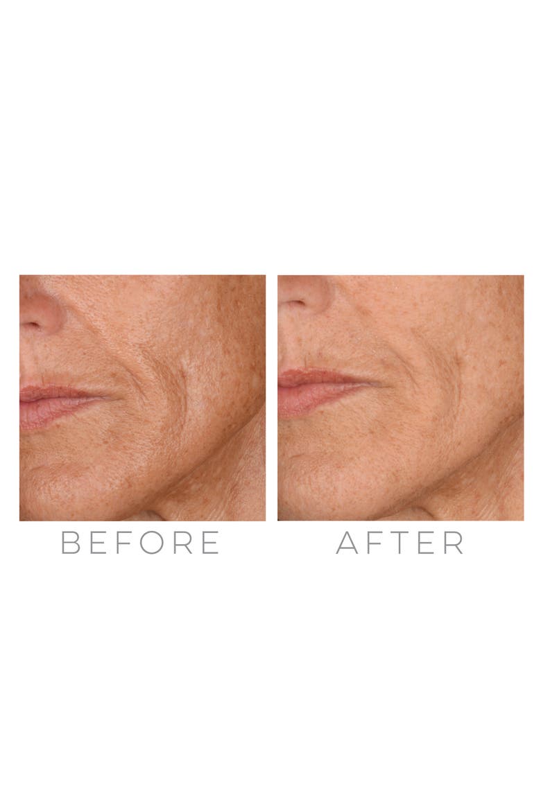 GloPRO® Microneedling Regeneration Tool with FACE & BODY MicroTip™ Attachments, Alternate, color, NO COLOR