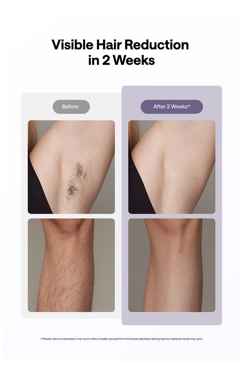 Ice Cooling IPL Hair Removal Device, Alternate, color, PURPLE
