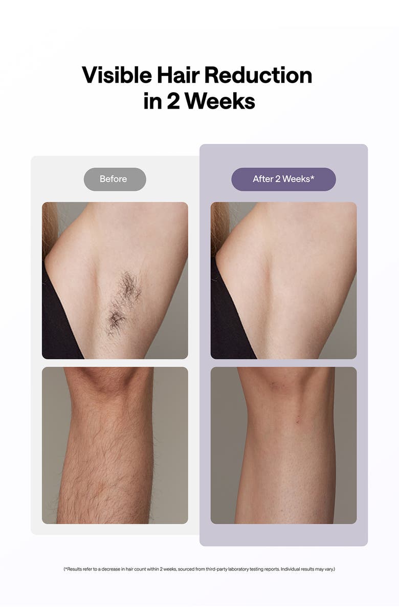 ULIKE Ice Cooling IPL Hair Removal Device, Alternate, color, Purple