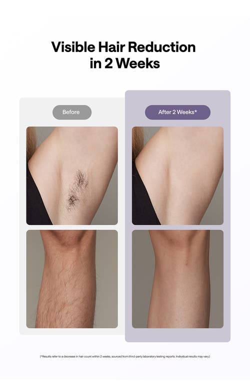 Ulike Ice Cooling Ipl Hair Removal Device In Purple