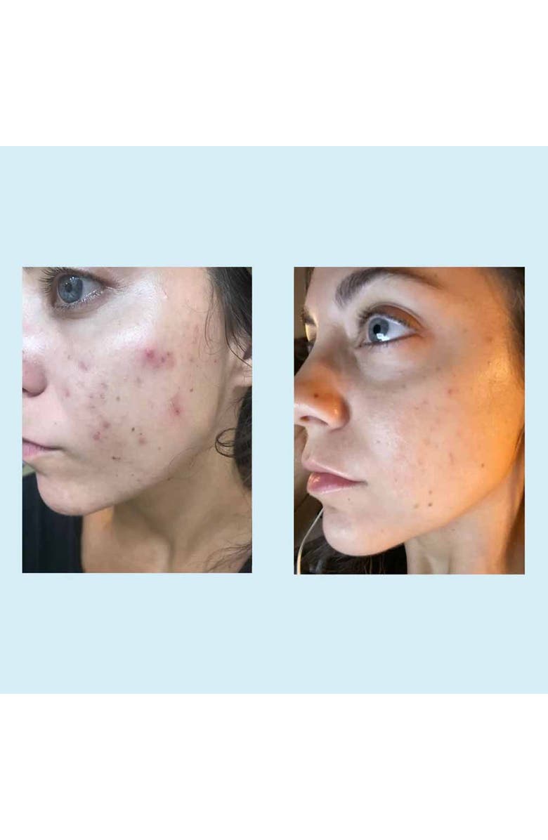 Perfect Image Tri-Clarity Peel Pads 25% 30ct, Alternate, color, NO COLOR