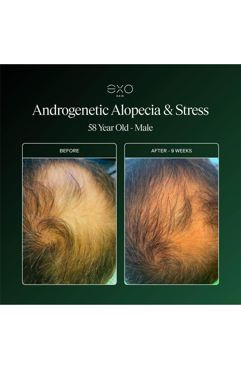 Exoceuticals Exo Fortify Revitalizing Hair & Scalp Treatment, Alternate, color, Black