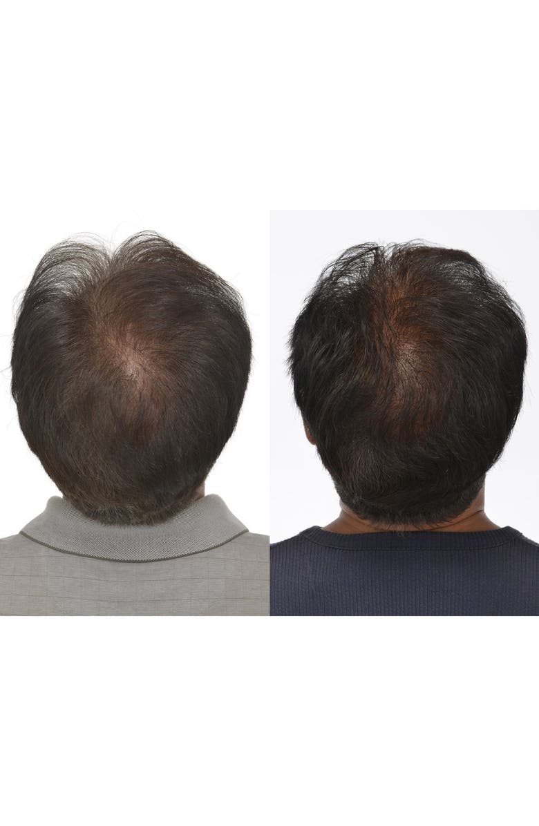 IGROW <sup>®</sup> Laser Hair Rejuvenation System, Alternate, color, 