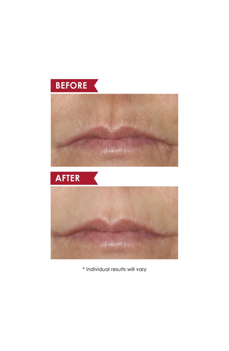 Dermelect SMOOTH UPPER LIP PROFESSIONAL Perioral Anti-Aging Treatment, Alternate, color, White