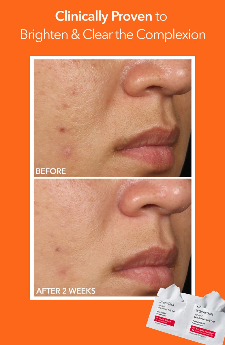 Dr. Dennis Gross Skincare Alpha Beta<sup>®</sup> Peel Extra Strength Formula - 30 Applications, Alternate, color, 