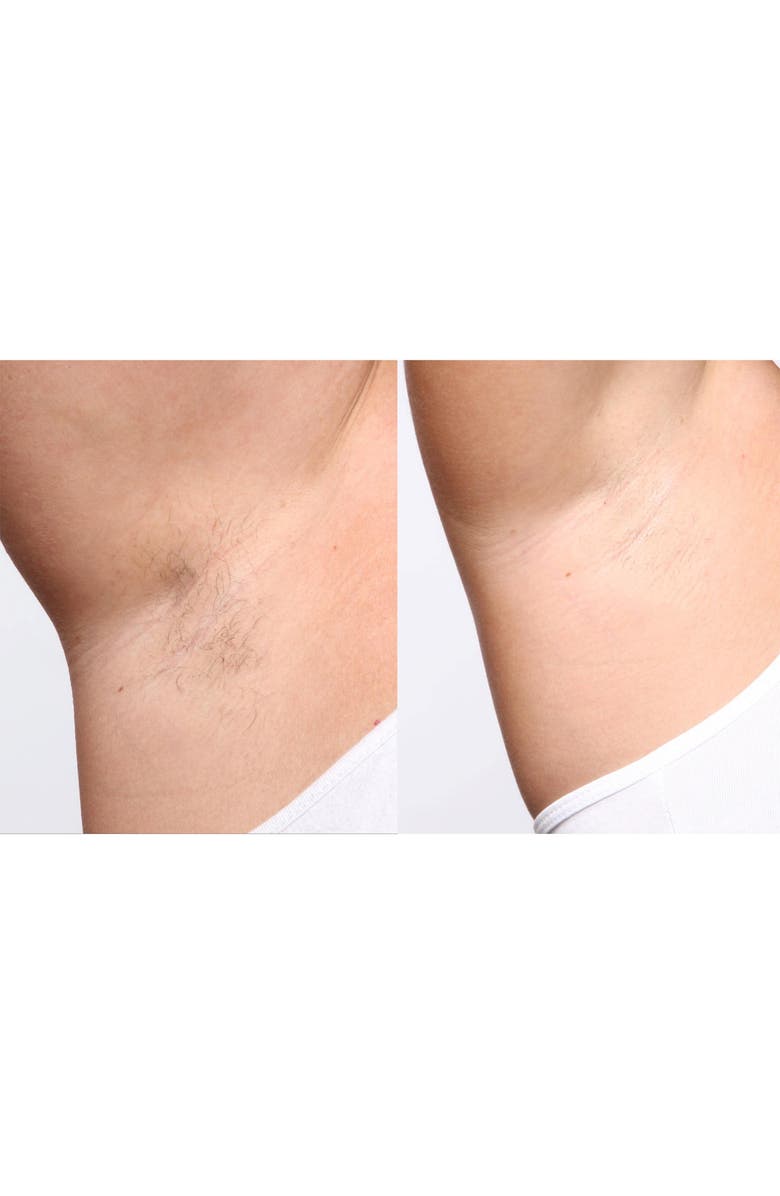 Silk'n Flash&Go Jewel Hair Removal Device, Alternate, color,