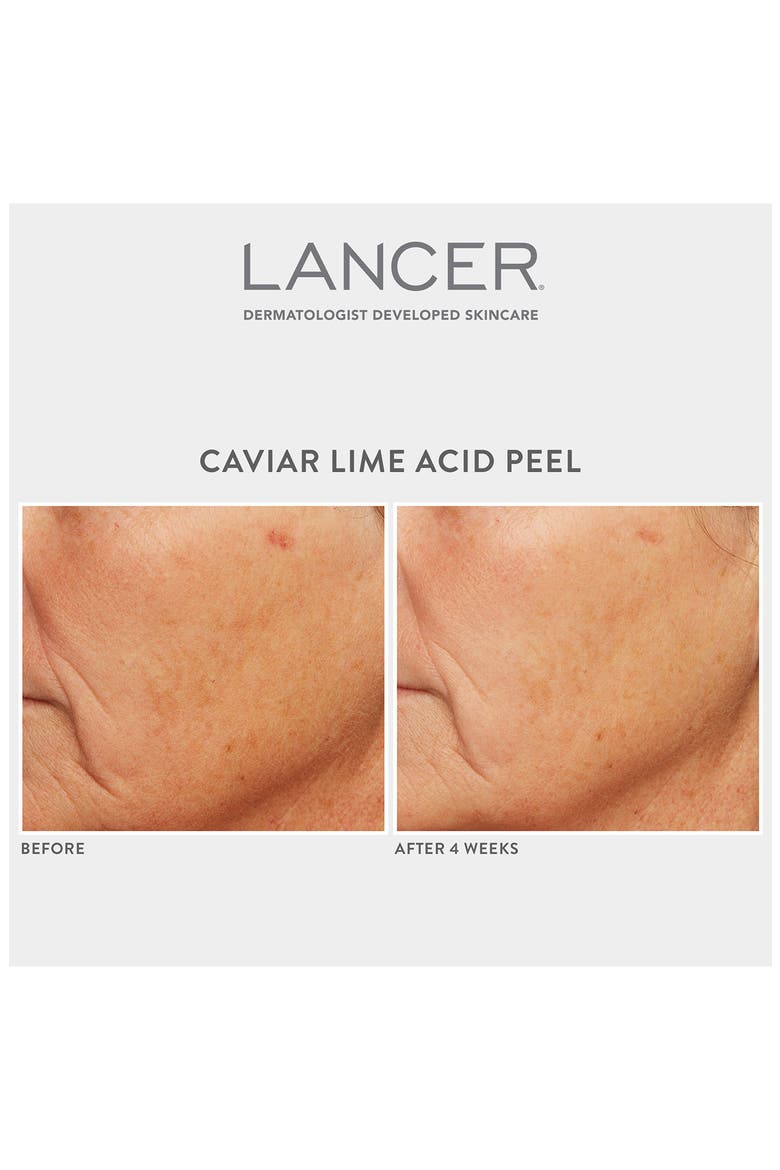 Caviar Lime Acid Peel, Alternate, color, NO COLOR