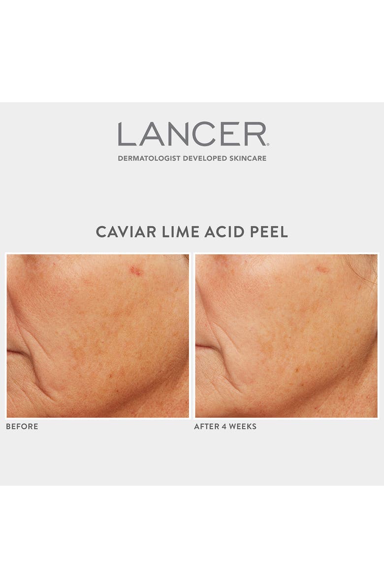 LANCER Skincare Caviar Lime Acid Peel, Alternate, color, 