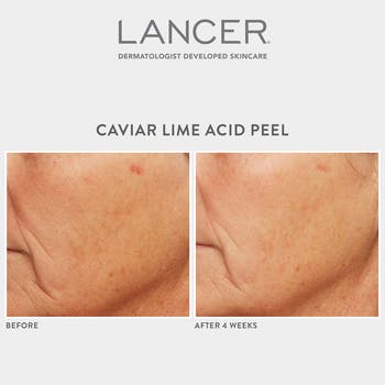 Lancer Caviar Lime Acid Peel 1.7 oz w/Glycolic Acid outlet Phytic & Retinol 1.7oz