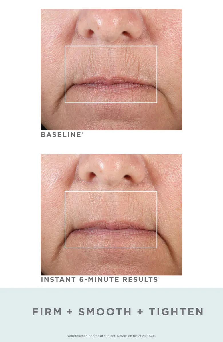 NuFACE<sup>®</sup> FIX<sup>®</sup> Mini Starter Kit, Alternate, color,