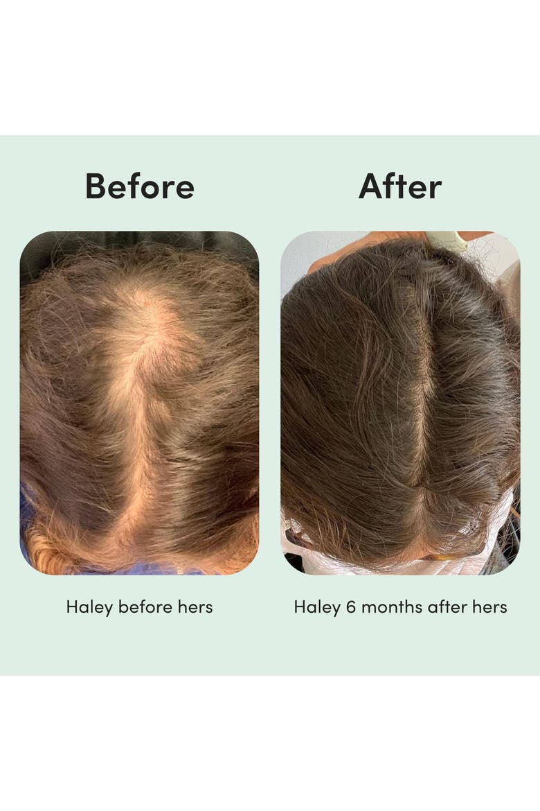 Topical Minoxidil Solution 2% Hair Regrowth Treatment, Clinically Proven, Alternate, color, White