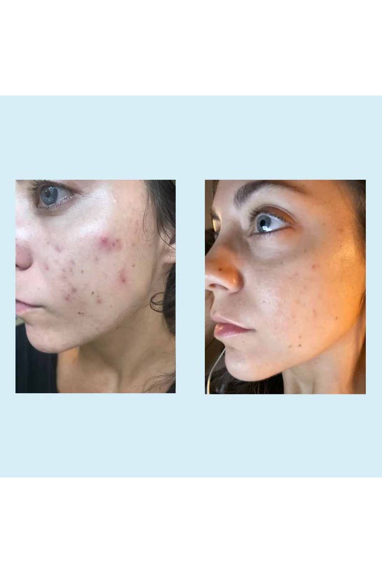 Tri-Clarity Peel Pads 25% 30ct, Alternate, color, None