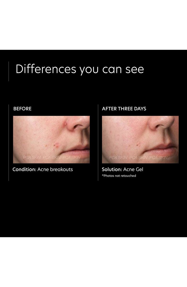 PCA Skin Acne Gel, Alternate, color, 