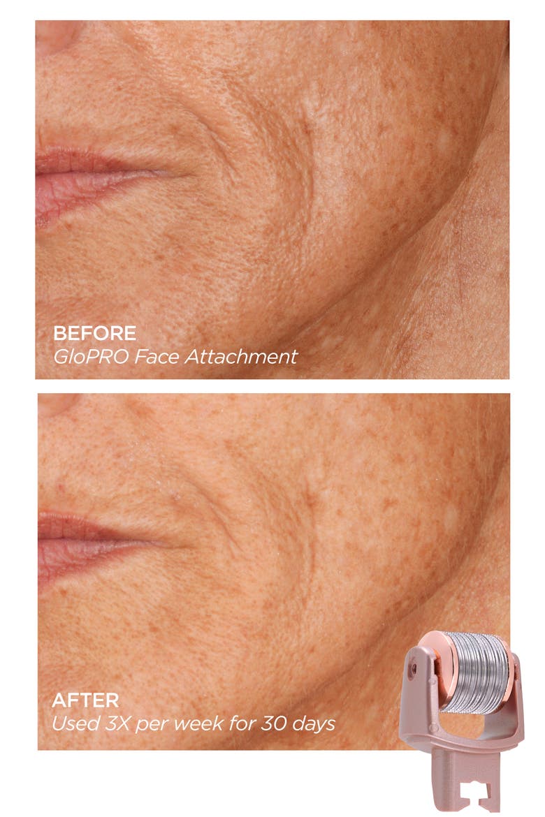 GloPRO® Microneedling Regeneration Facial Set (Nordstrom Exclusive), Alternate, color, NO COLOR