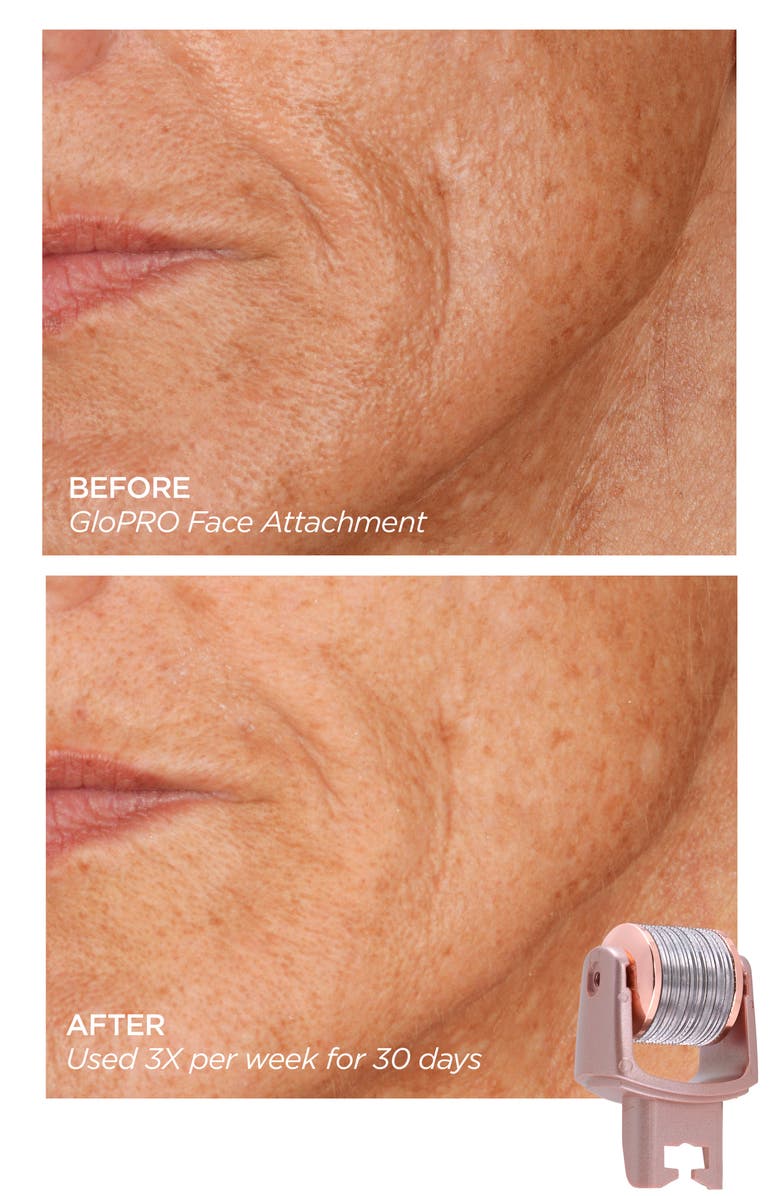 BeautyBio GloPRO<sup>®</sup> Microneedling Regeneration Facial Set, Alternate, color,