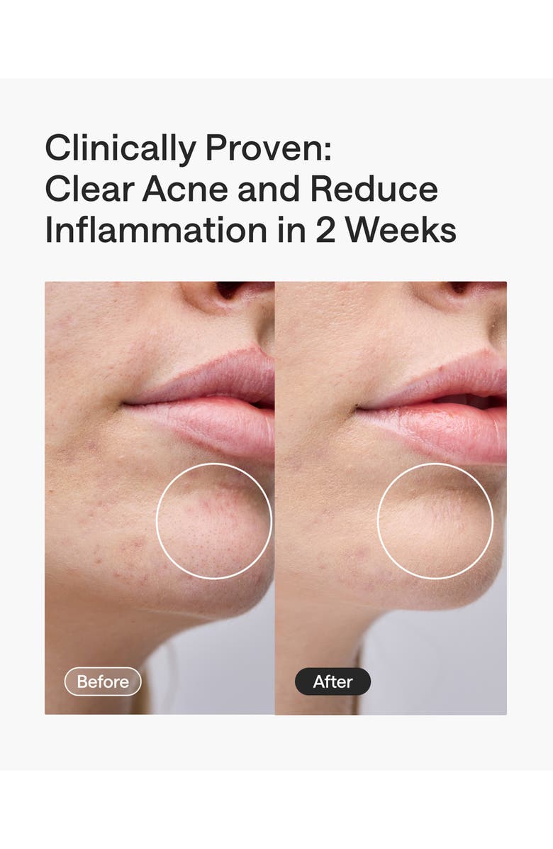 ULIKE ReGlow 4-in-1 LED Light Therapy Mask, Alternate, color, Silver