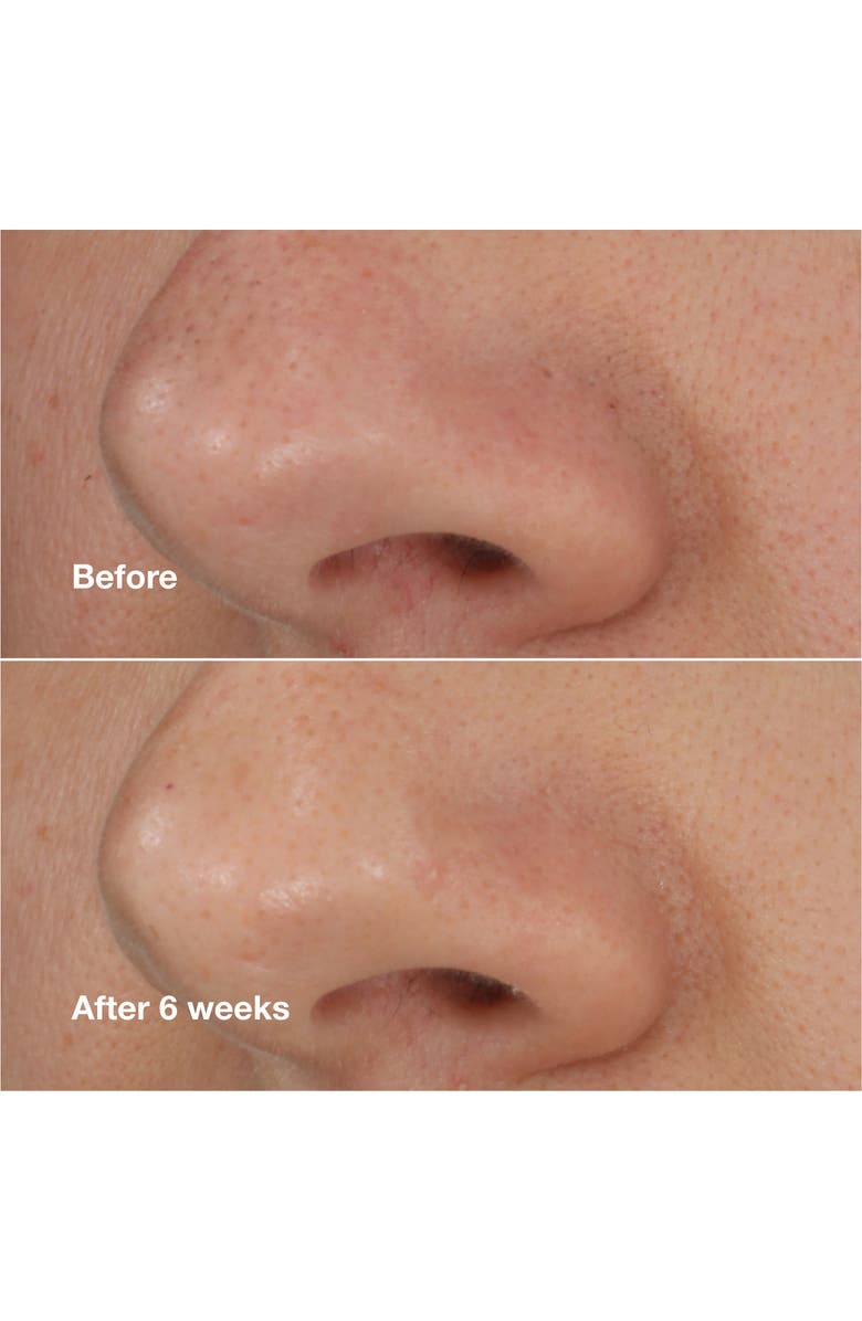 Clinique Blackhead Solutions Self-Heating Blackhead Extractor, Alternate, color, 