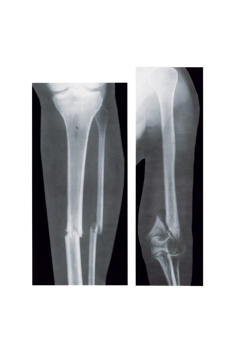 Broken Bones X-Rays, Alternate, color, Multicolor
