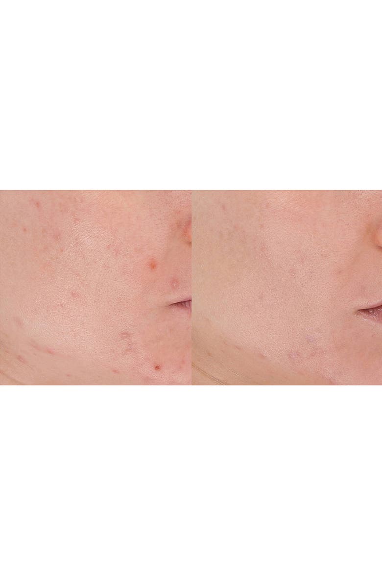 LightStim<sup>®</sup> for Acne LED Light Therapy Device, Alternate, color, 