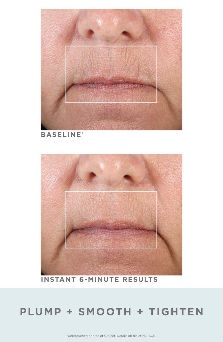 NuFACE<sup>®</sup> FIX Line Smoothing Device, Alternate, color, 