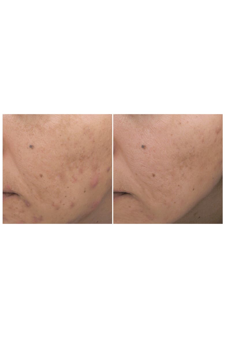 Acne Cream Spot Treatment, Alternate, color, NO COLOR