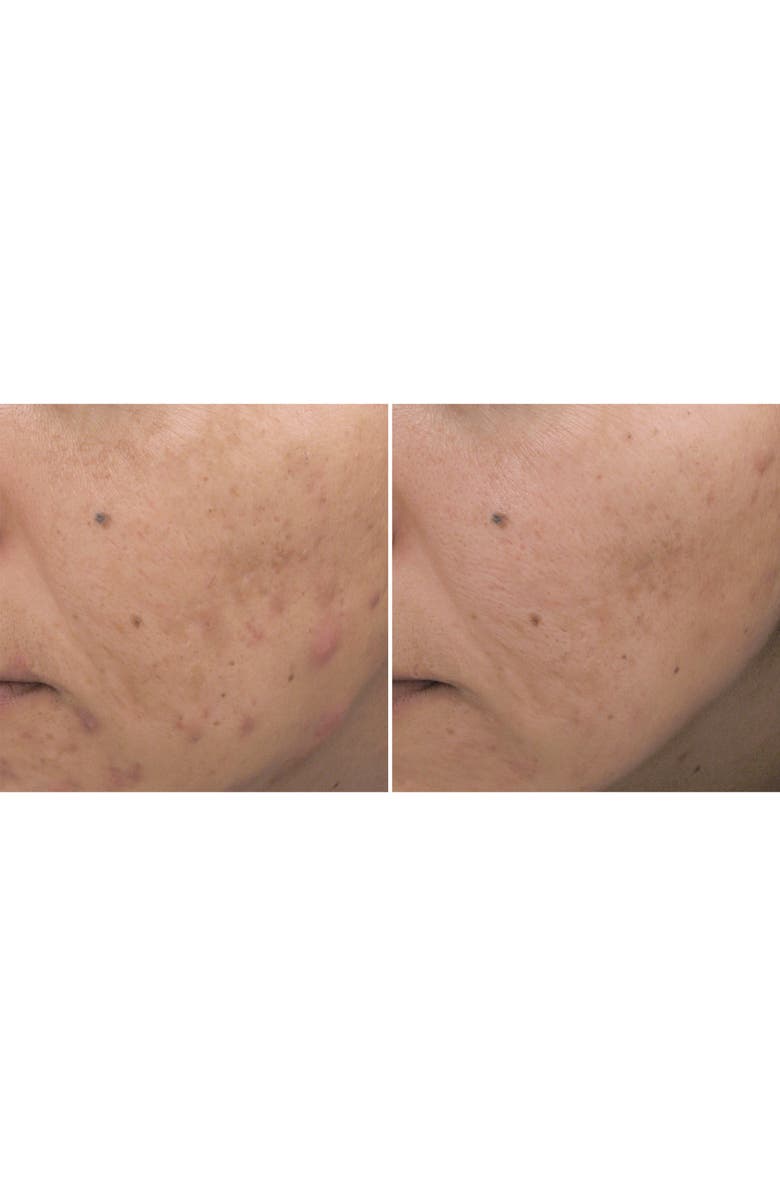 PCA Skin Acne Cream Spot Treatment, Alternate, color,