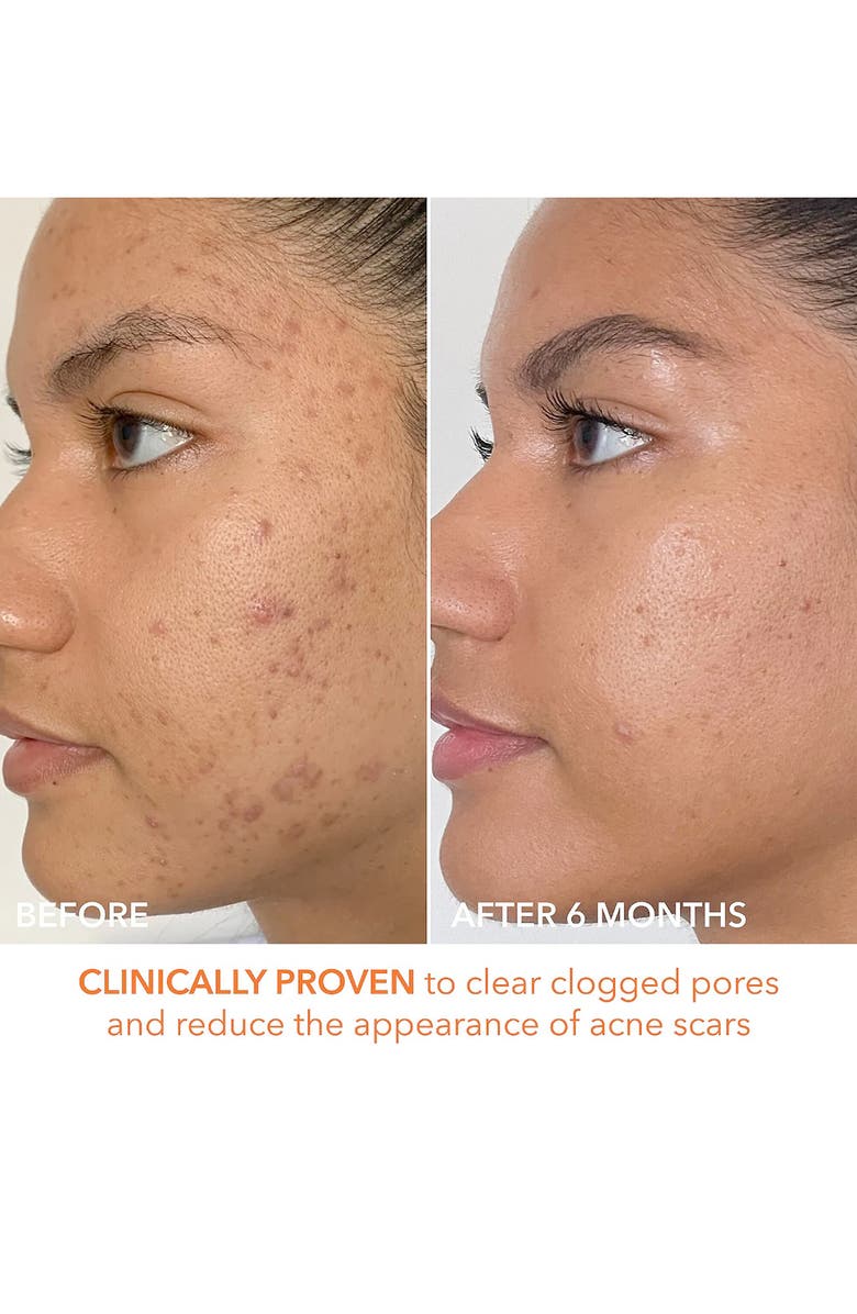 Dr. Dennis Gross Skincare Alpha Beta<sup>®</sup> Extra Strength Daily Peel - 60 Applications, Alternate, color,