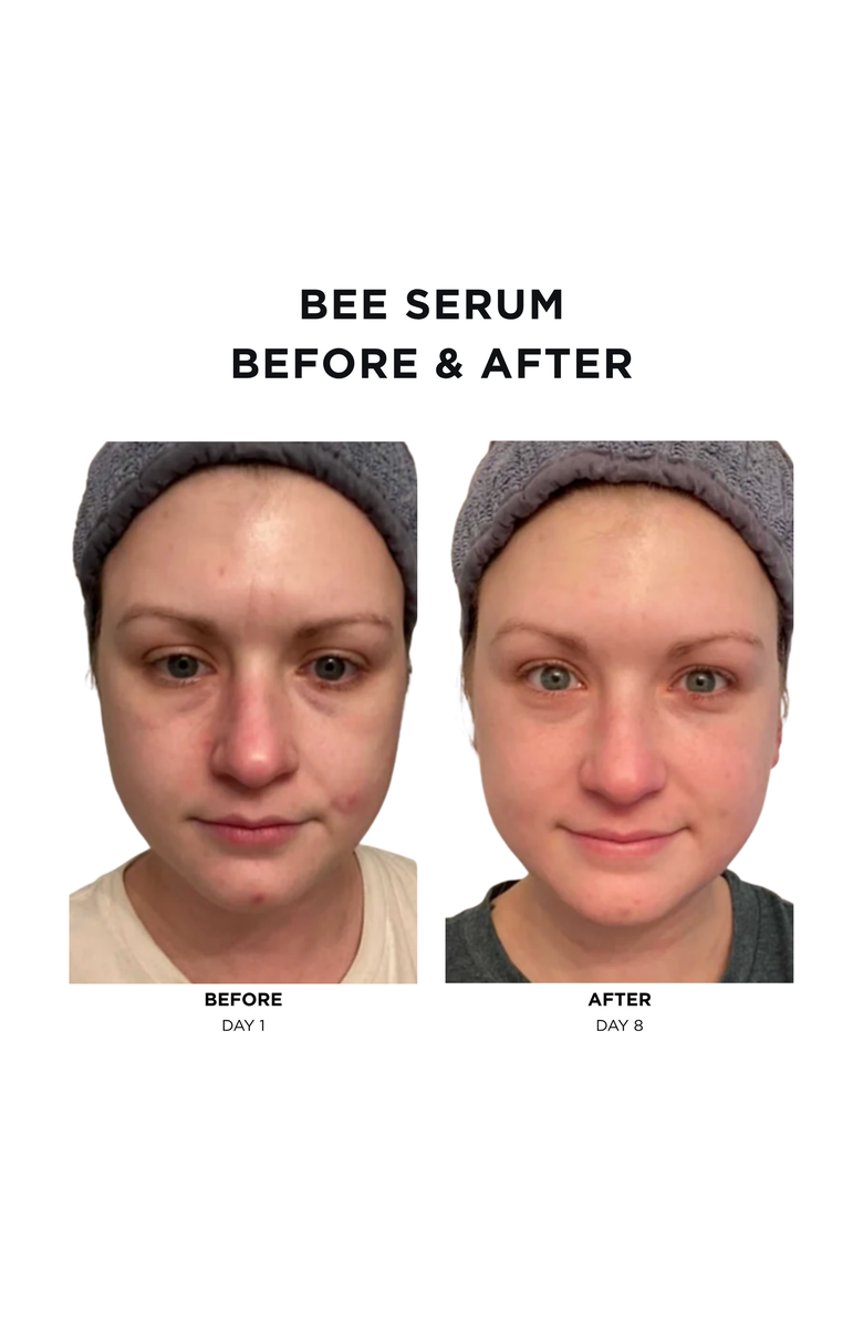 Intoxicated Cosmetics Bee Serum + Antidote Moisturizer |  Boost Blood Circulation | Reduce Acne with Purified Bee Venom & Royal Epigen P5 &  Fine Line Smoothing in a Hydrating Daily Moisturizer, Alternate, color, NO COLOR