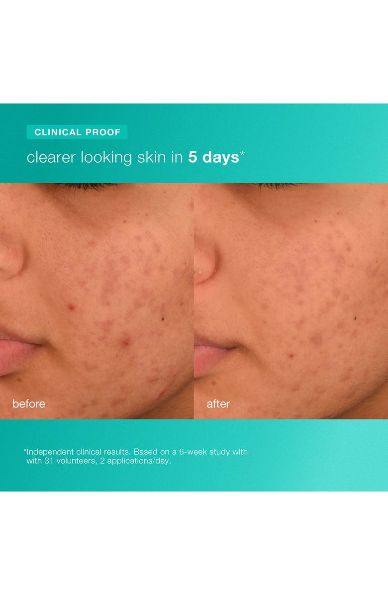 dermalogica<sup>®</sup> Acne Biotic Moisturizer, Alternate, color, 