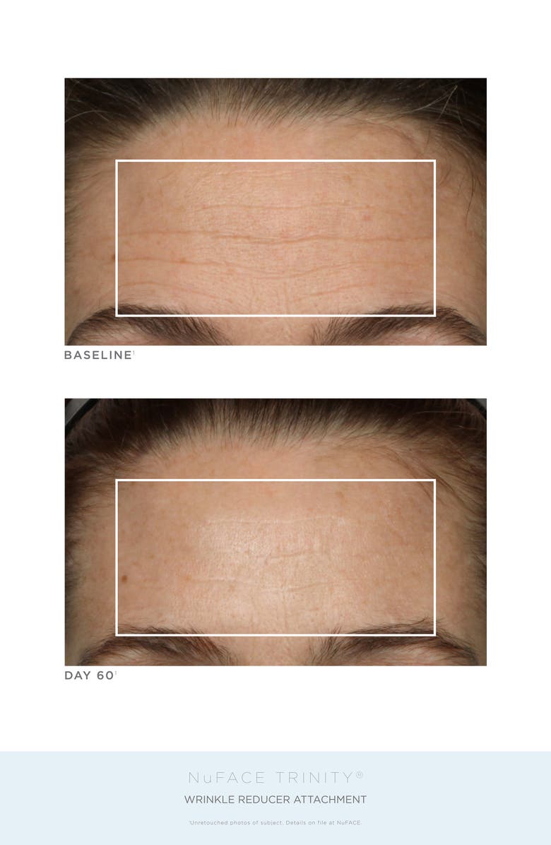 NuFACE<sup>®</sup> Trinity Advanced Lift Collection (Nordstrom Exclusive) USD $614 Value, Alternate, color,