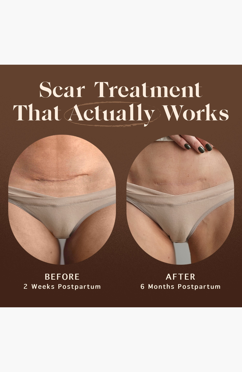 Nēmah Restorative Scar Treatment, Alternate, color, NO COLOR