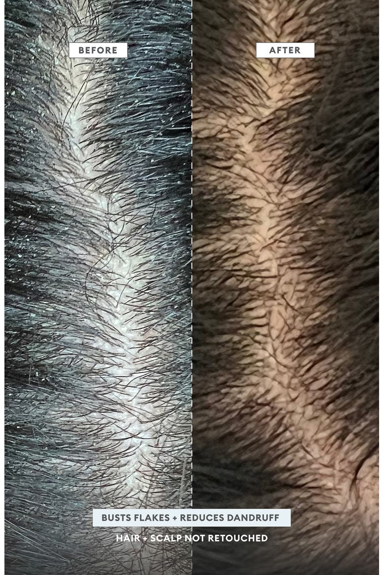 Scalp Revival™ MegaStrength+ Dandruff Relief Shampoo Charcoal + AHA/BHA with Salicyic Acid 3%, Alternate, color, NO COLOR
