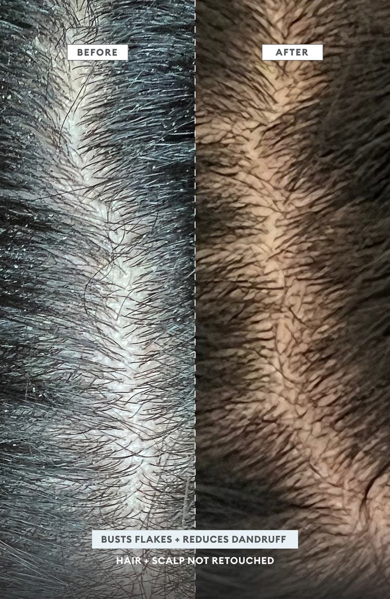 Scalp Revival<sup>™</sup> MegaStrength+ Dandruff Relief Shampoo Charcoal + AHA/BHA with Salicyic Acid 3%