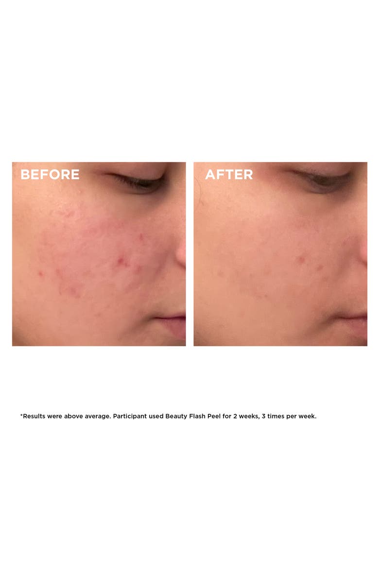 Beauty Flash Peel with BHA & AHA, Alternate, color, NO COLOR