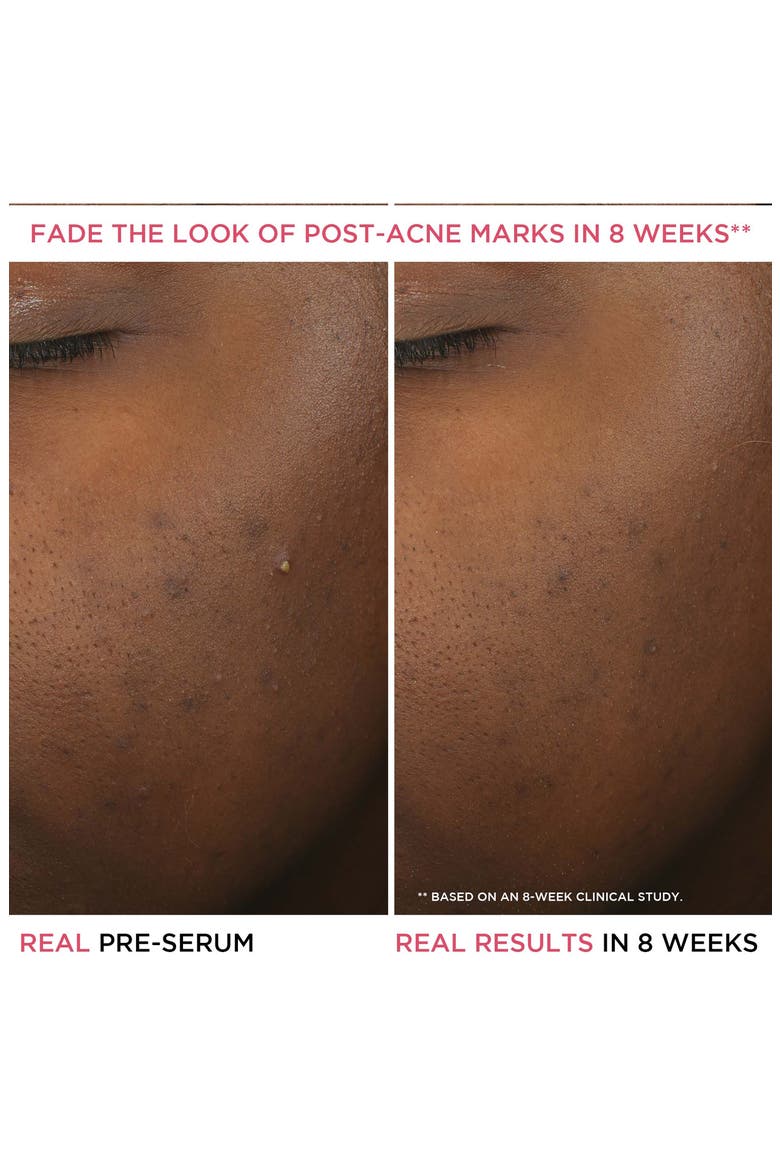 Bye Bye Breakout Salicylic Acid Acne Serum, Alternate, color, NO COLOR