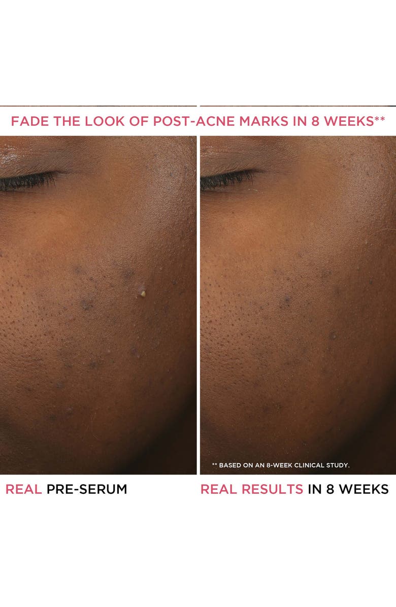 IT Cosmetics Bye Bye Breakout Salicylic Acid Acne Serum, Alternate, color,