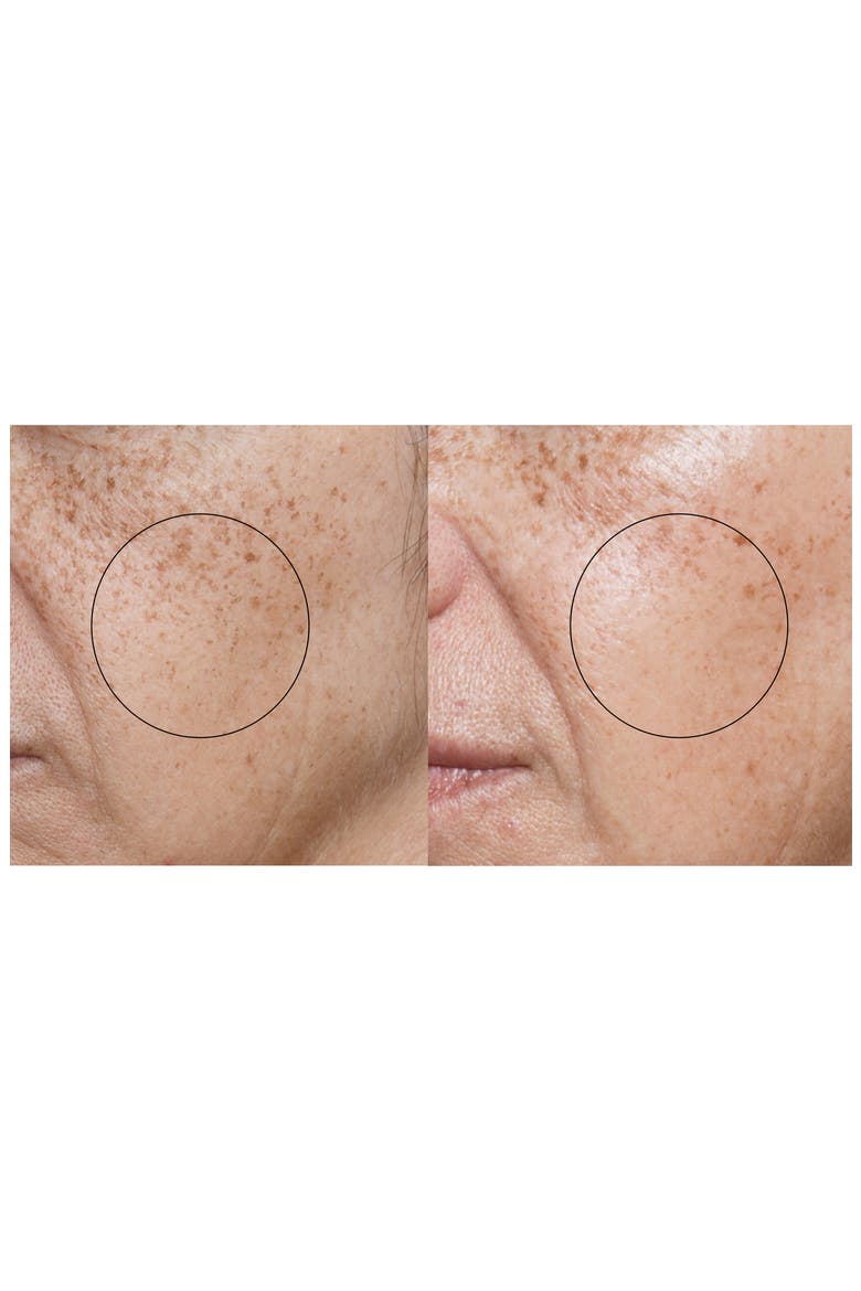 ReVit™ Microdermabrasion Device, Alternate, color, NO COLOR
