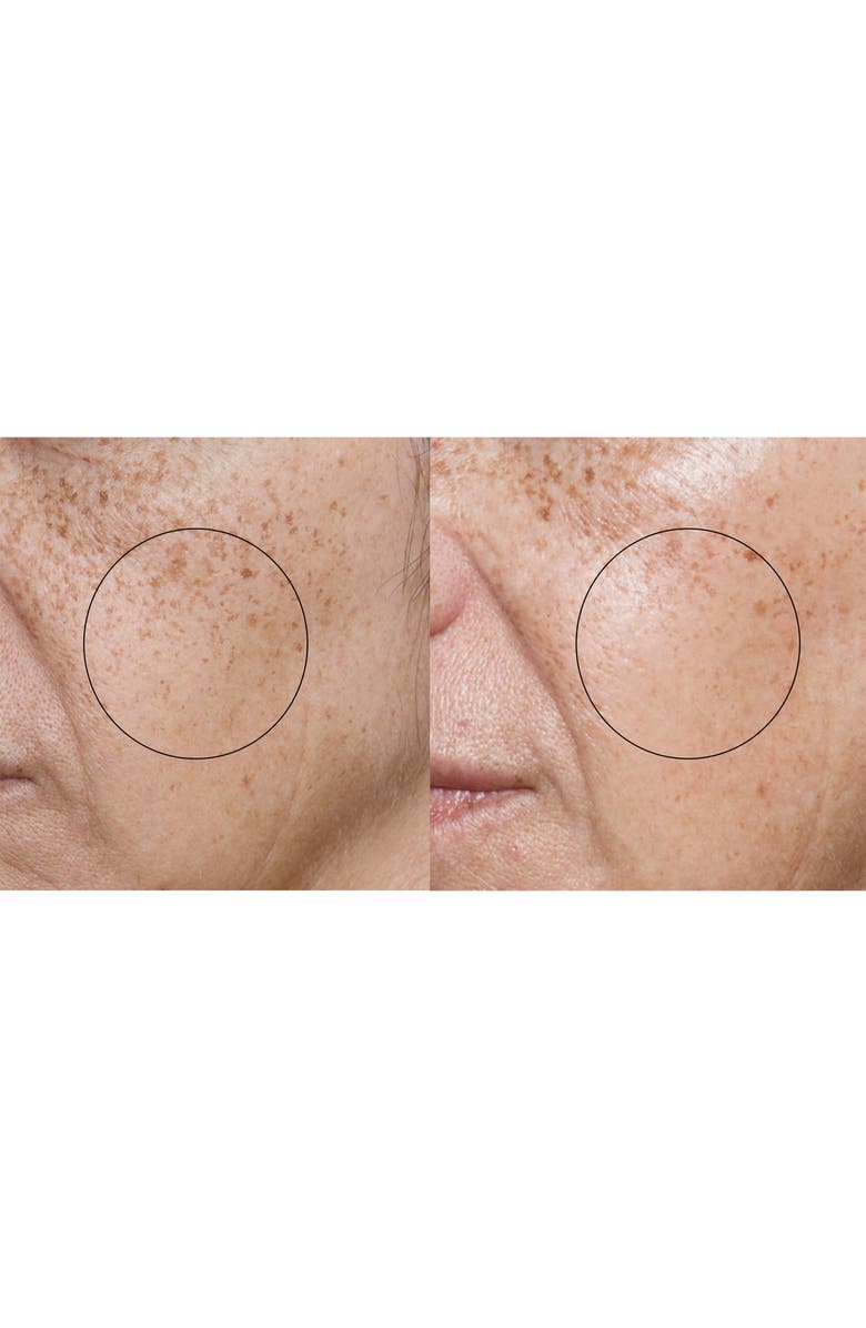 Silk'n ReVit<sup>™</sup> Microdermabrasion Device, Alternate, color, 