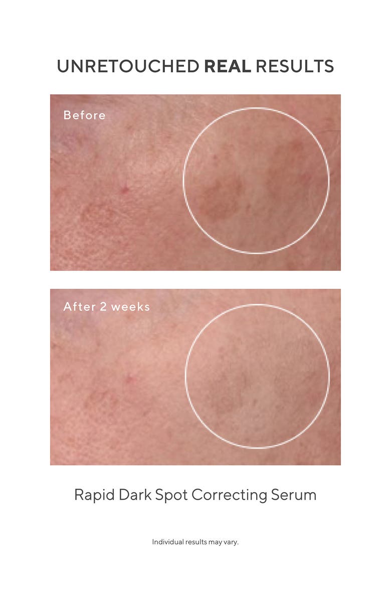 Murad<sup>®</sup> Under the Microscope: The Dark Spot Correctors Set (Limited Edition) $187 Value, Alternate, color, 